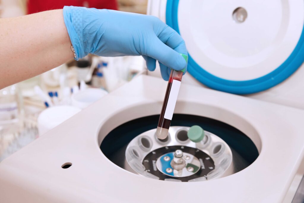 Tube of blood is placed in a medical centrifuge for plasma lifting