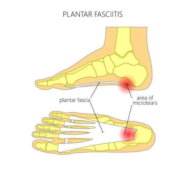 Illustration plantarfascian och det smärtande området (rött) som uppkommer om belastningen blir för stor. 