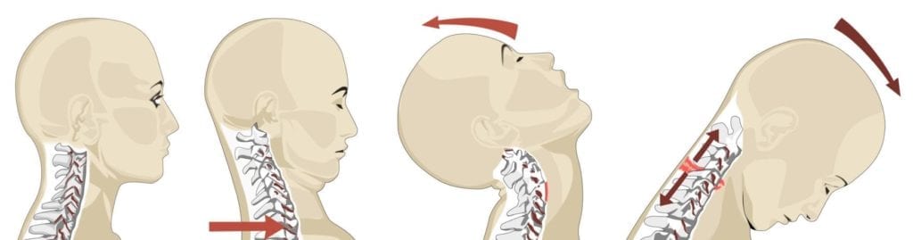 illustration av vad som händer vid whiplashskada