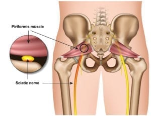 På bilden ser man bäckenet samt lårbenen och ländryggen. Illustrationen visar även musklerna Piriformis och ischiasnerven